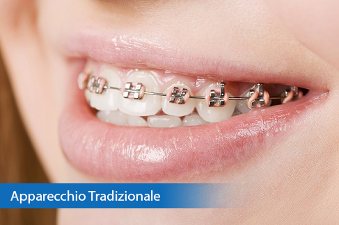 Apparecchio Denti Tradizione