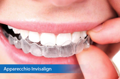 Invisalign apparecchio invisibile a Padova